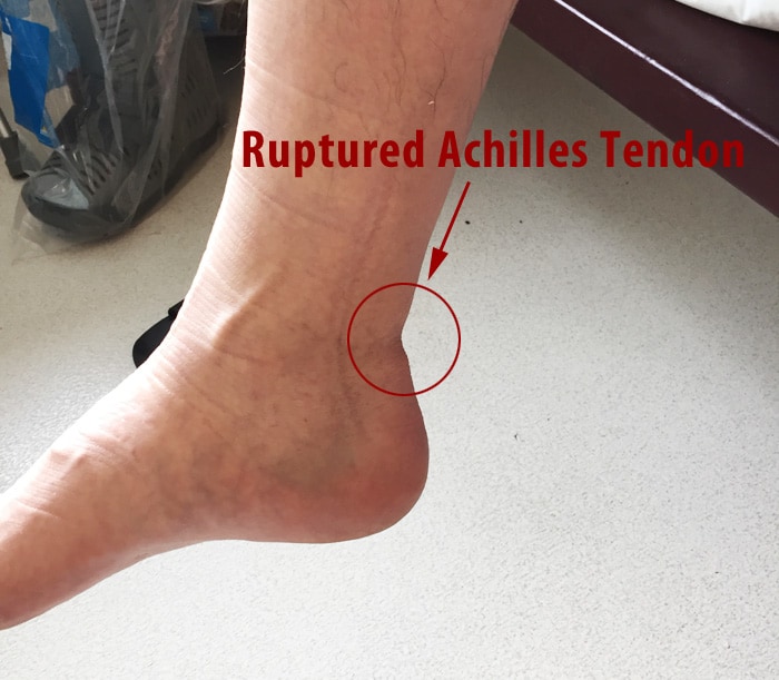 Tendon Healing Time- How Long Does it Take?